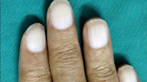 THIS common nail condition could be a red flag for liver cirrhosis