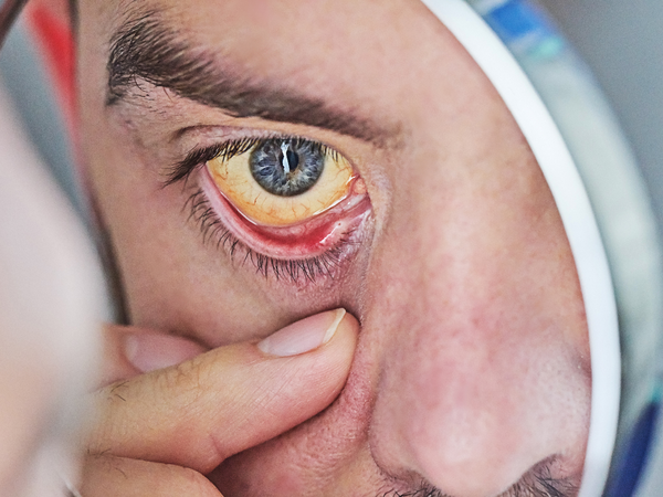 Jaundice: Yellowing of the skin and eyes