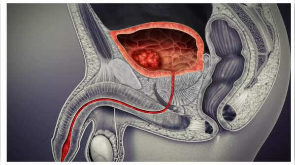 Change in urine color indicating bladder cancer