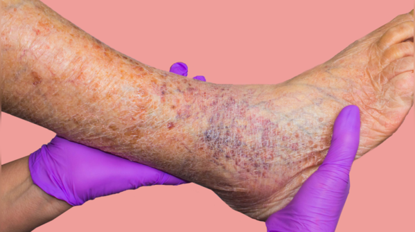 Varicose veins