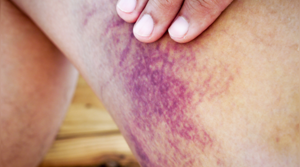 Bruising on legs