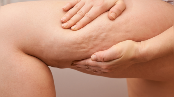 Visible cellulite
