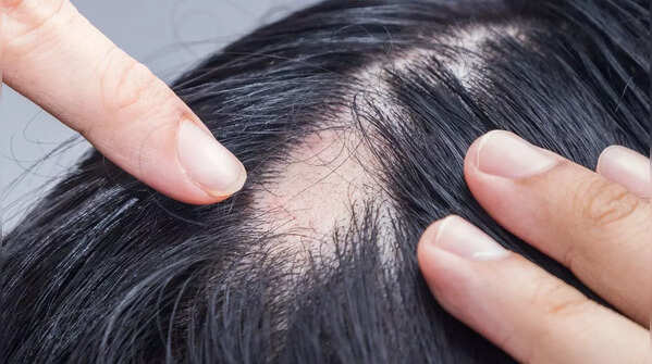 Autoimmune diseases (Alopecia Areata, Lupus)