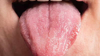 How HIV can affect your tongue and oral health